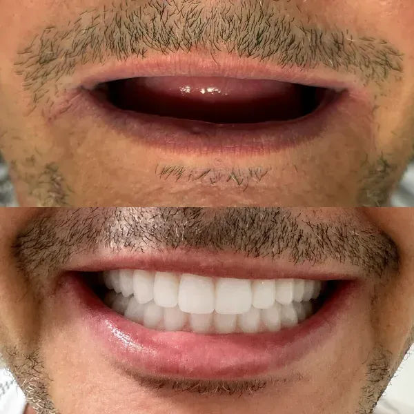 imgi_3_antes-depois-1