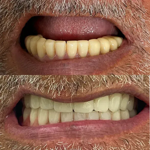 imgi_5_antes-depois-0